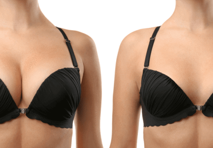 Breast_Augmentation