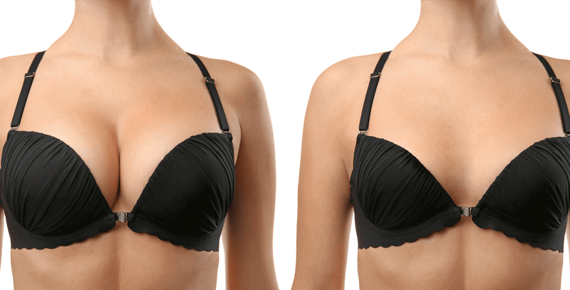 Breast_Augmentation