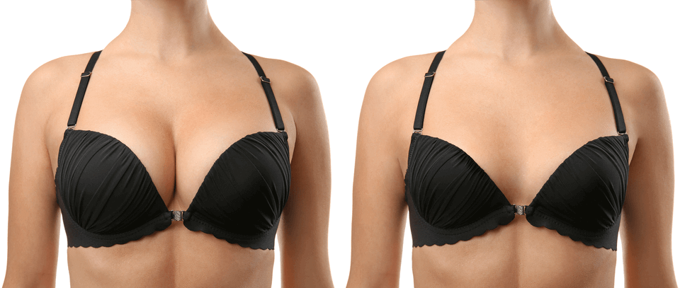 Breast_Augmentation