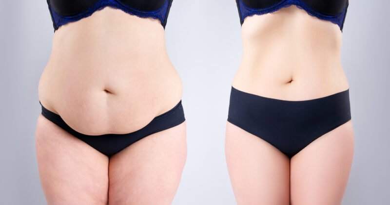 abdominoplasty-or-tummy-tuck-surgery-causes-procedure-recovery
