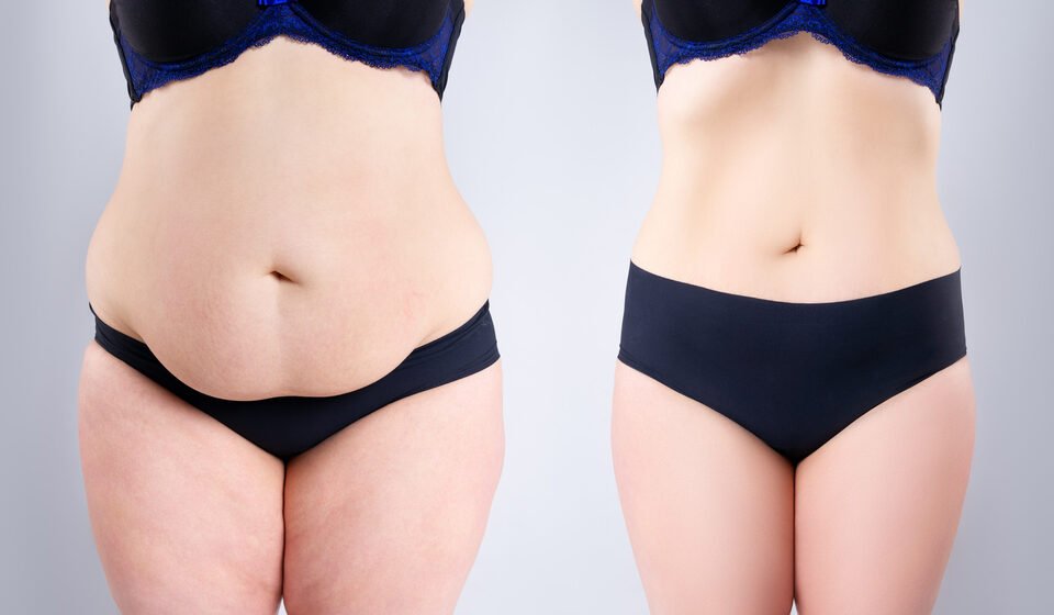 abdominoplasty-or-tummy-tuck-surgery-causes-procedure-recovery