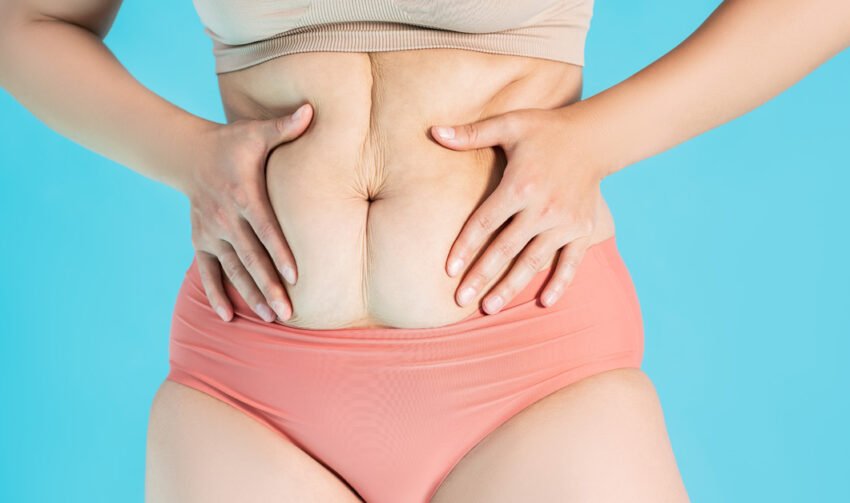 abdominoplasty-vs-tummy-tuck-image
