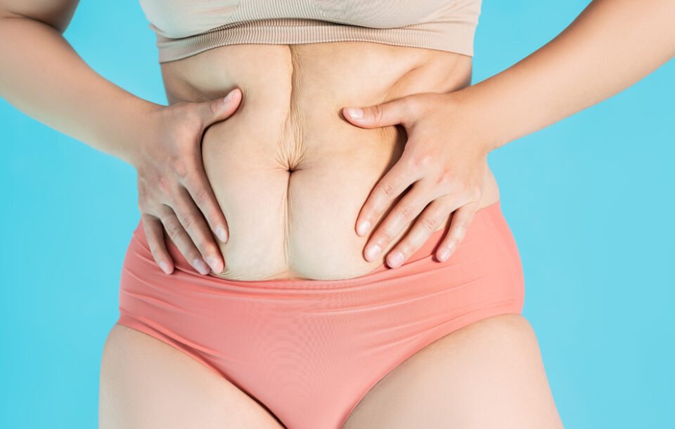 abdominoplasty-vs-tummy-tuck-image