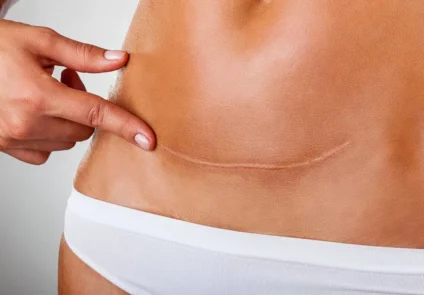 tummy-tuck-scar