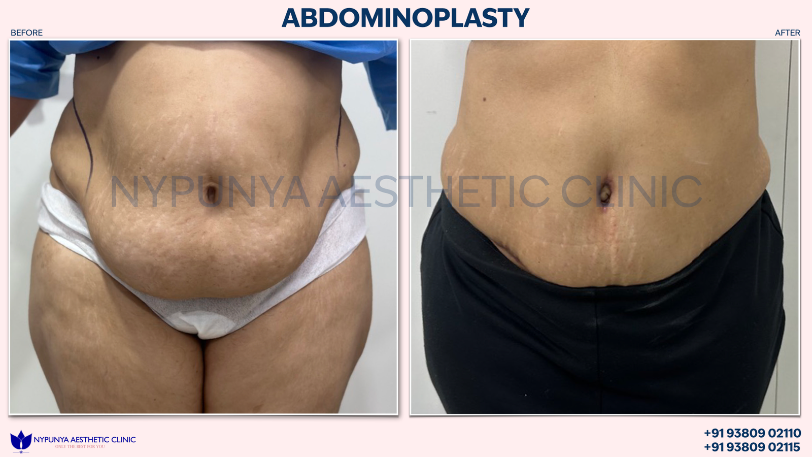 Abdominoplasty_After_Belly_Tightening_India_13.png