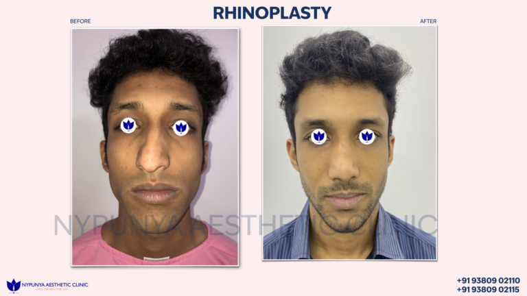 Before-After-Image-Crooked-Nose-Correction-India-Rhinoplasty 1