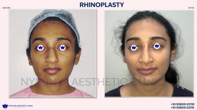 Before_After_Hump_Rhinoplasty_India_07