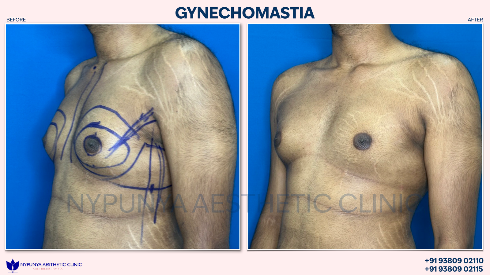 Before_After_Male_Breast_Lipo_10