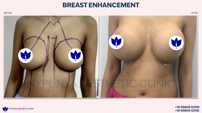 Breast_Augmentation_After_Procedure_India_09