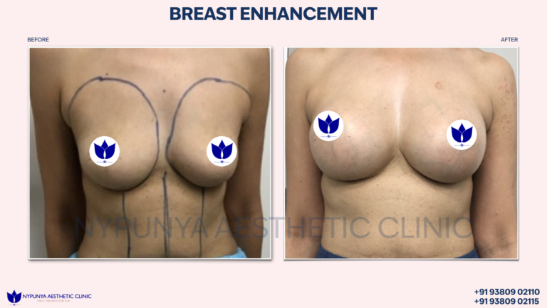Breast_Augmentation_Enhanced_Bust_India_23