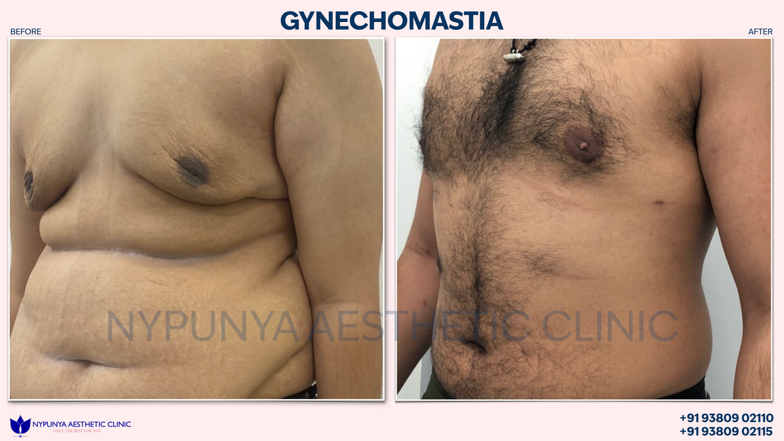 Chest_Liposuction_Gynecomastia_Results_05