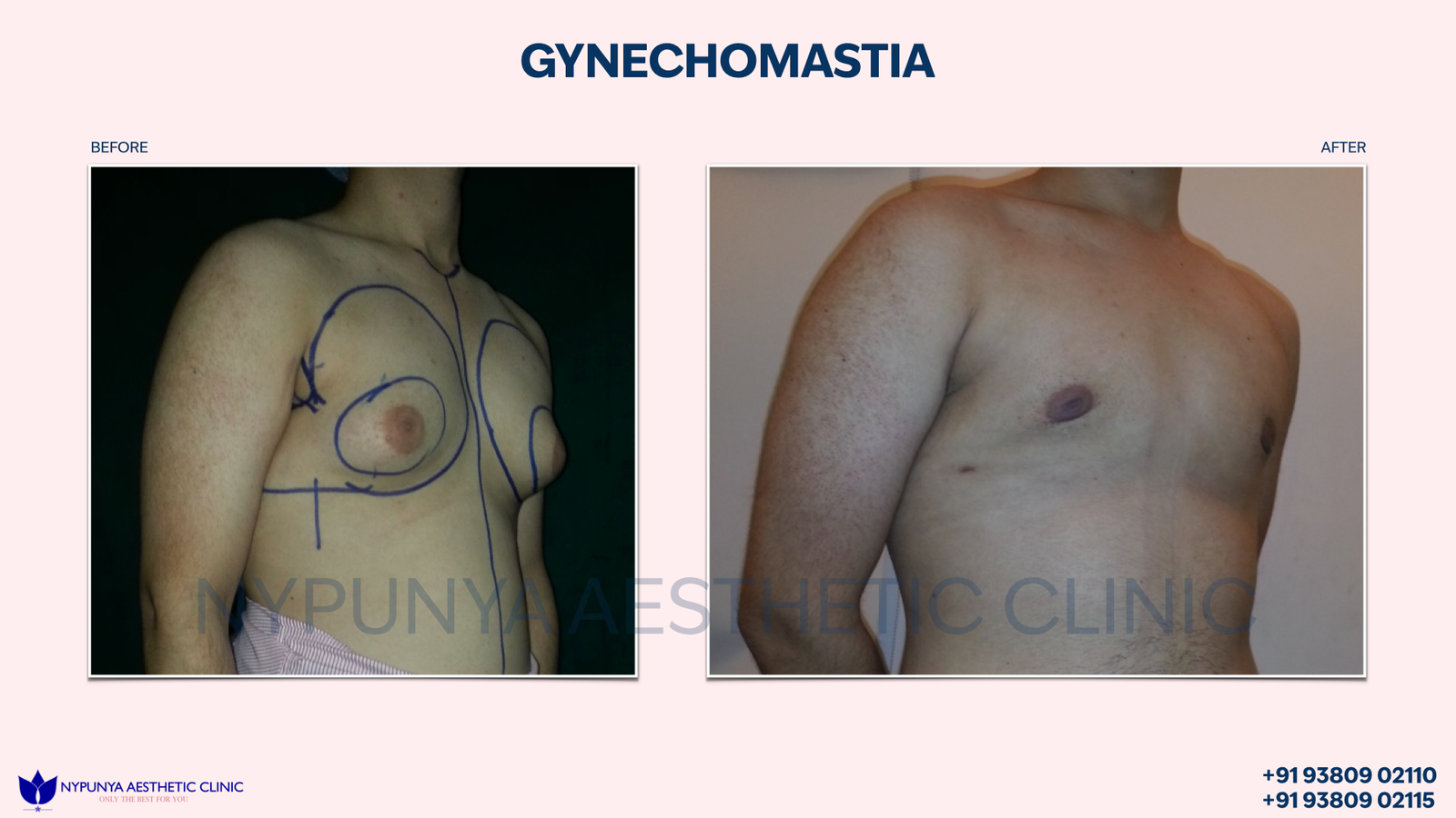 Flat_Chest_After_Gynecomastia_Liposuction_15