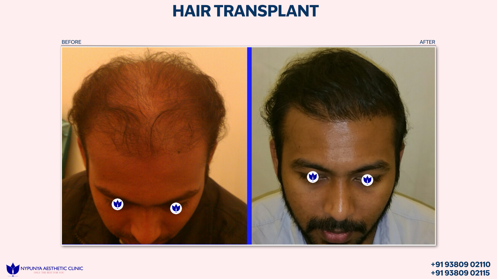 Hair_Transplant_Seamless_Growth_India_32