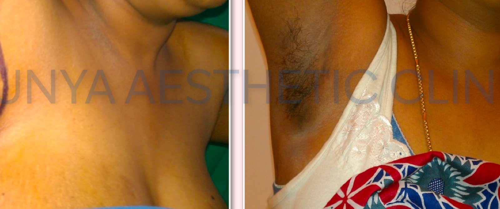 Structural fat grafting 1