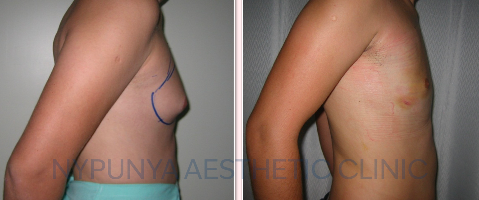 Structural fat grafting 2