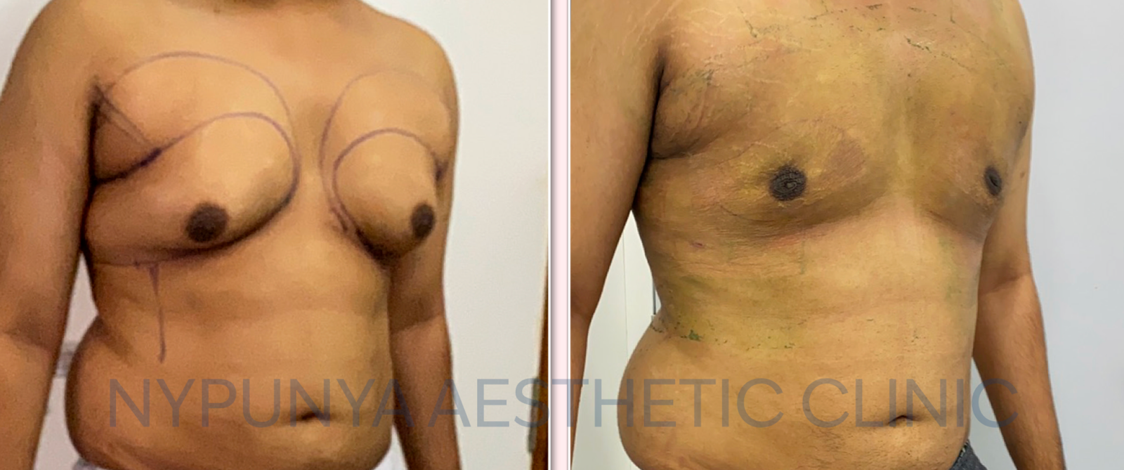 Structural fat grafting 3