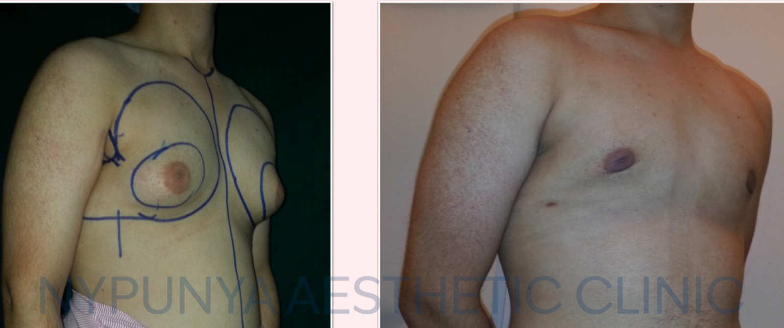 Structural fat grafting 4