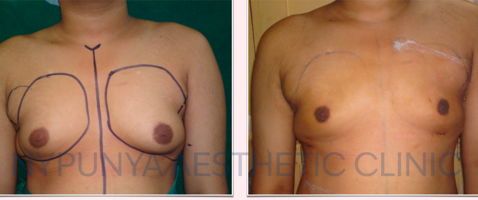 Structural fat grafting 5