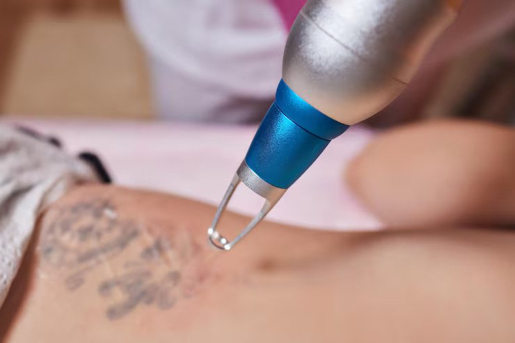 laser tattoo removal 2