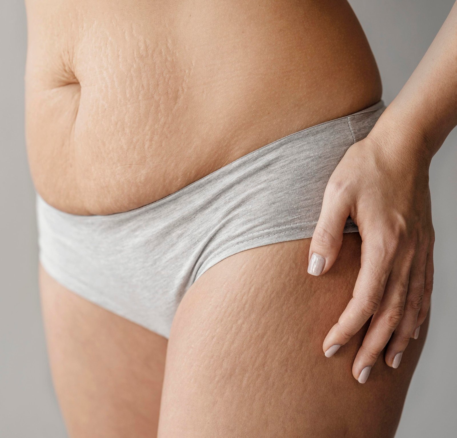 stretch mark remova;