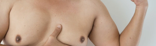 gynaecomastia_service