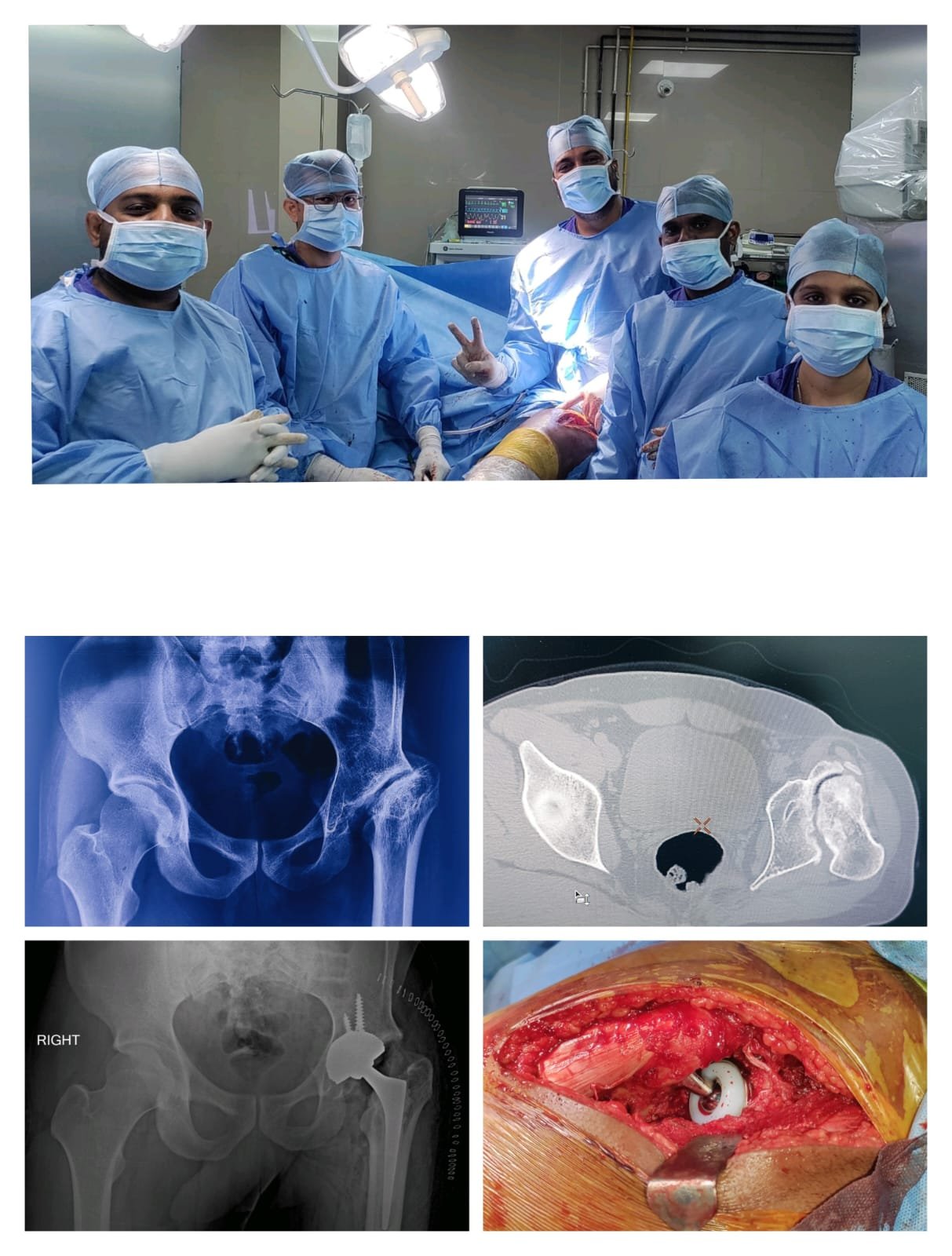 Complex Primary Total Hip Replacement